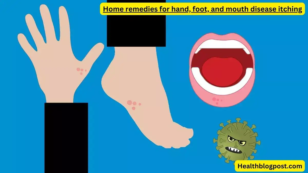 Home remedies for hand, foot, and mouth disease itching